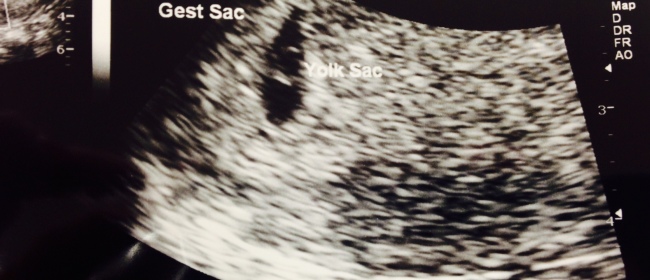 First Pregnancy Update – Week 5